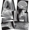 Broken Bones X-Rays